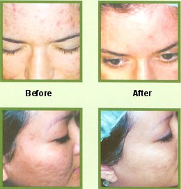 Click to enlarge before & after pictures